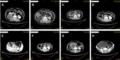 Case report: Kidney perivascular epithelioid cell tumor treated with anti-VEGFR tyrosine kinase inhibitor and MTOR inhibitor